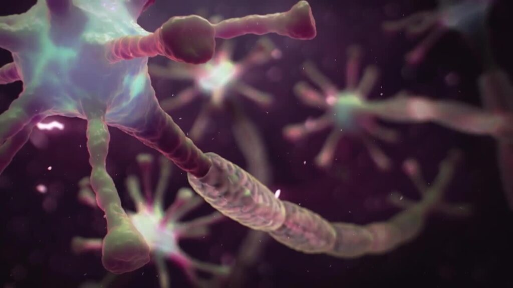 ¿Cuáles son las manifestaciones del síndrome de Guillain Barré?