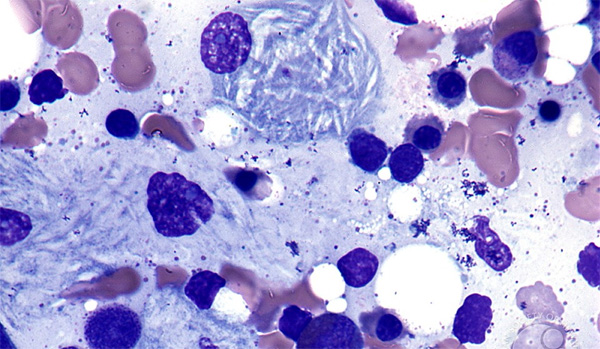 ¿Qué es la enfermedad de Gaucher?