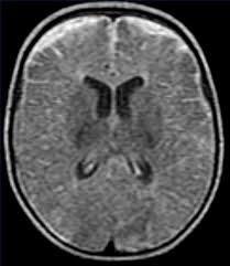 ¿Qué es el empiema subdural?