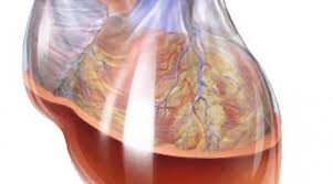 ¿Qué es un derrame pericárdico?