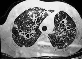 ¿Qué son las bronquiectasias?