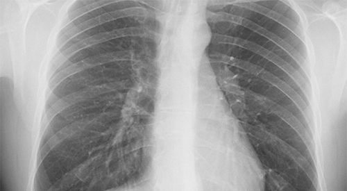 ¿Qué es la neumonía adquirida en la comunidad?