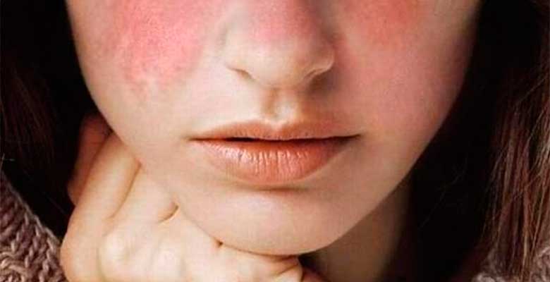 ¿En quienes es mas probable el lupus eritematoso sistémico? ¿En quienes es mas probable el lupus eritematoso sistémico?