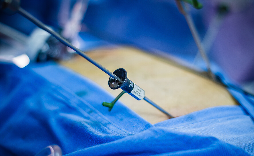 ¿Que son la Minilaparoscopía y las técnicas de mínima invasión en cirugía?