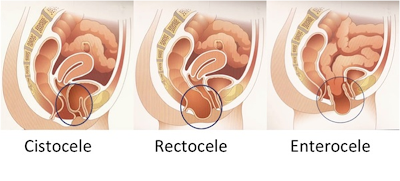 ¿Cuáles son las hernias vaginales?
