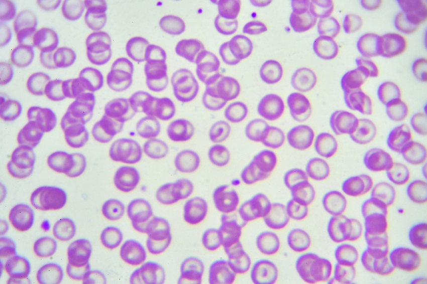 ¿Qué son las talasemias?