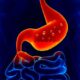 ¿Qué es la gastritis por Helicobacter pylori?