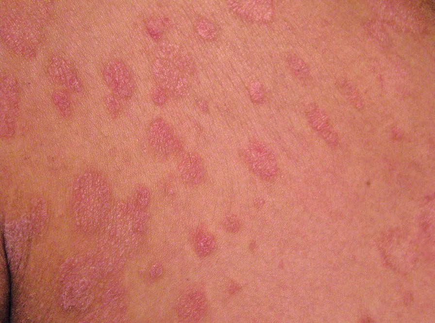 ¿Qué es la pitiriasis rosada?