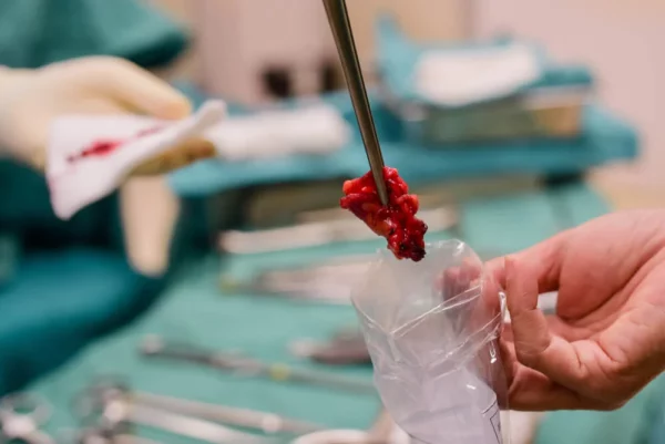 Técnicas para realizar una Biopsia