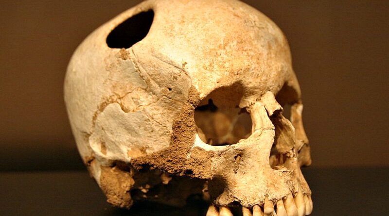 ¿Por que se hacían trepanaciones en la antigüedad?