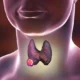 ¿Qué tipos de cáncer se desarrollan en la glándula tiroides?
