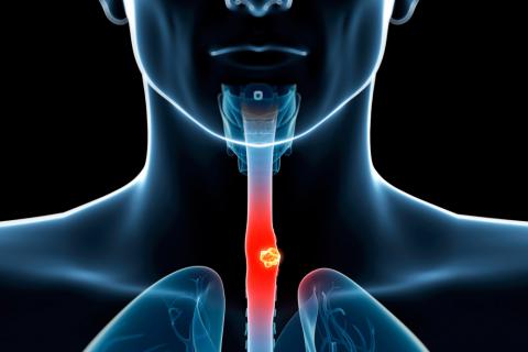 Tumores benignos del esófago