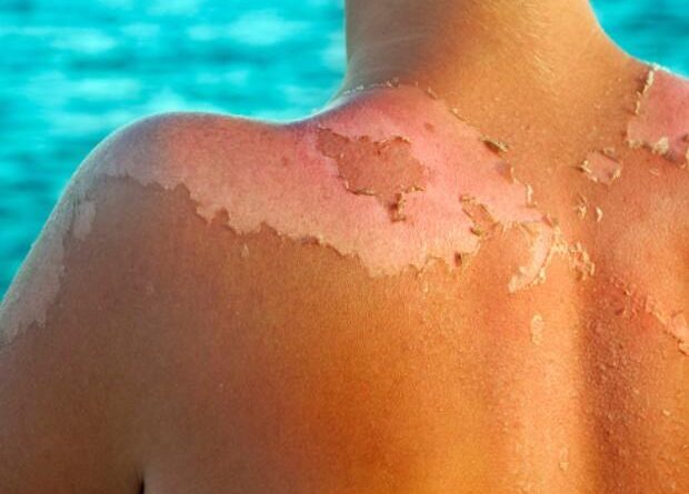 ¿Cómo se clasifican las quemaduras por su profundidad?