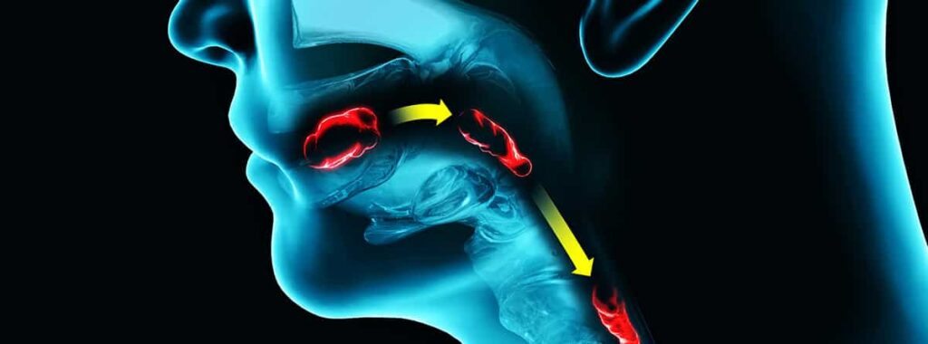 ¿Cuáles son las causas de disfagia bucofaríngea?