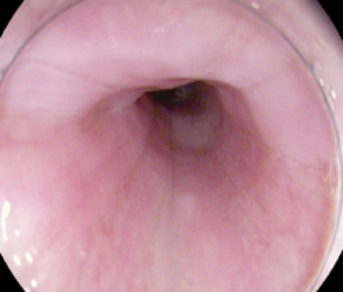 ¿Cuáles son las causas de disfagia esofágica?