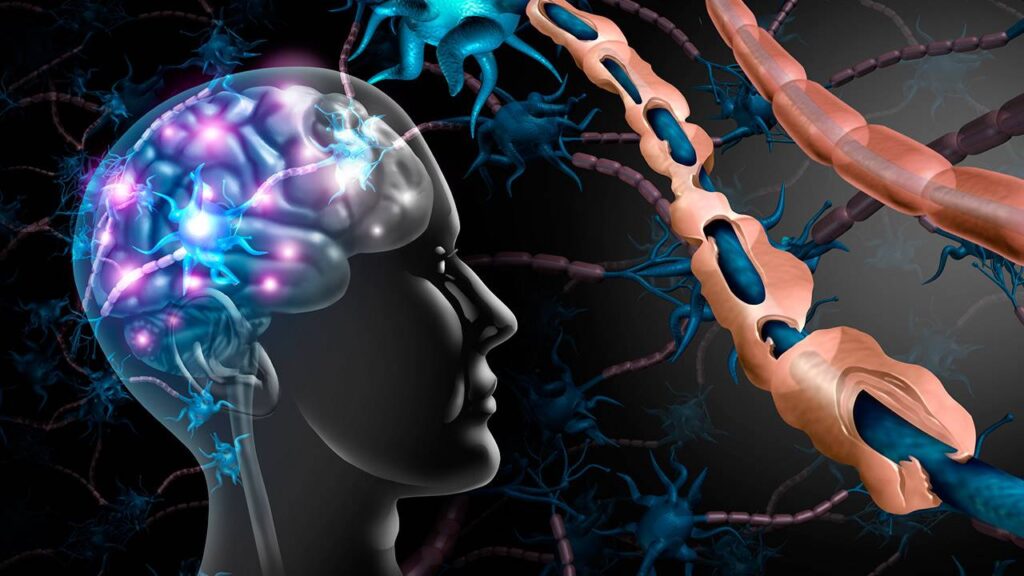 ¿Qué células participan en la patogenia de la esclerosis múltiple?