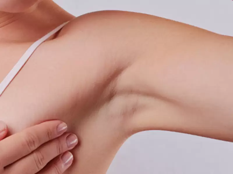 ¿Qué es la hidradenitis supurativa?