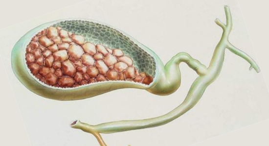 ¿Qué son los cálculos biliares?