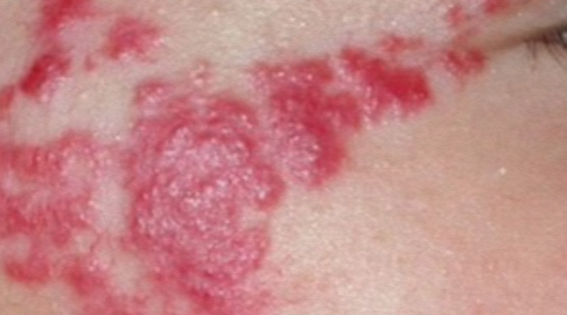 ¿Qué son los hemangiomas?