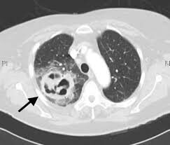 ¿Cuáles son las causas de absceso pulmonar?