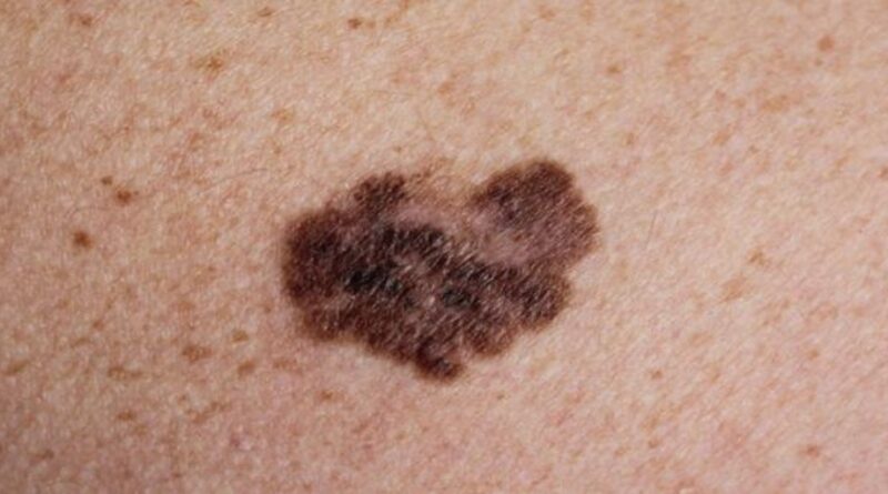 Factores de riesgo para melanoma