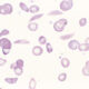 ¿Cómo se clasifican las hemoglobinopatías?