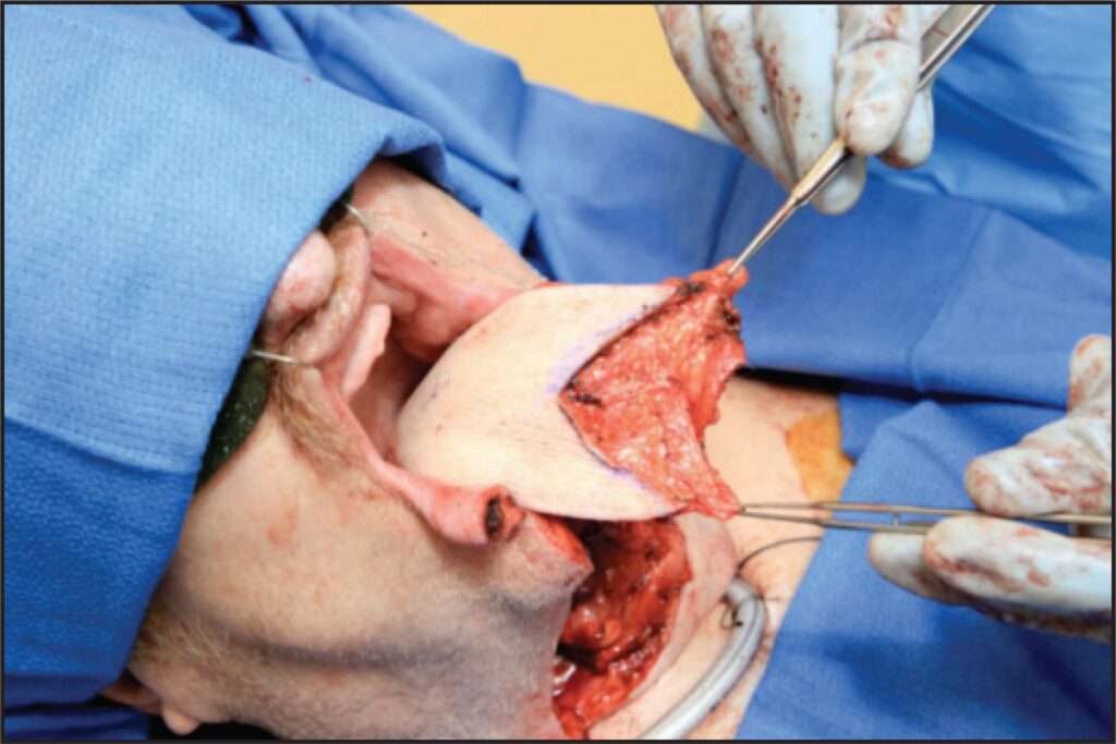 Transferencia de tejido libre en lesiones de cabeza y cuello