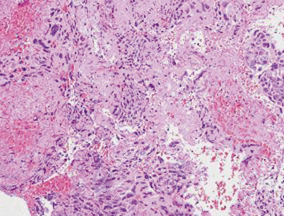 Tipos histológicos de neoplasia trofoblástica gestacional