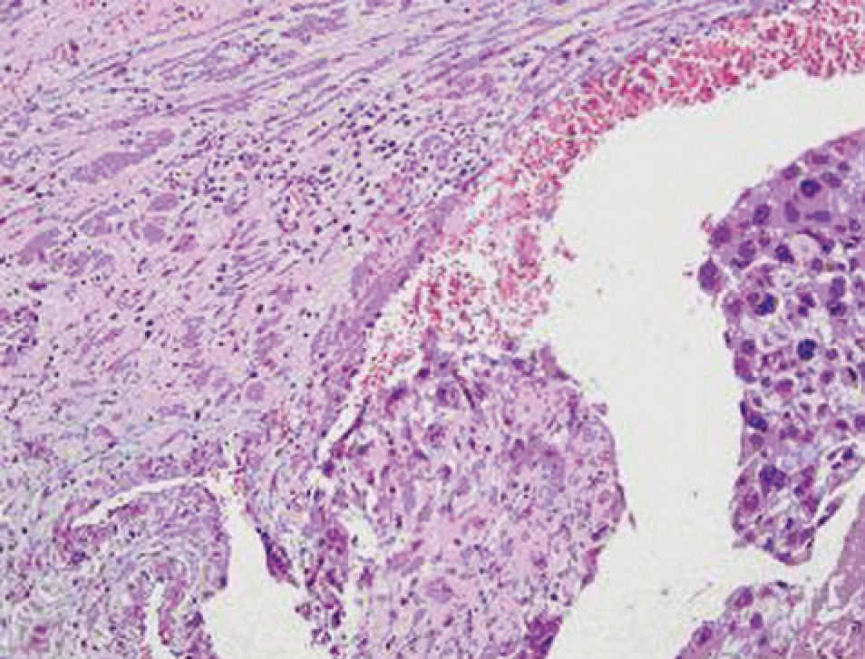 ¿Qué es la neoplasia trofoblástica gestacional?