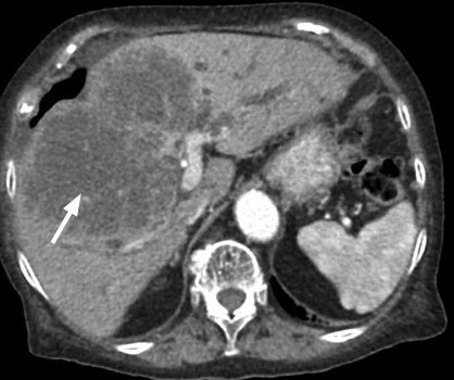 ¿Cuáles son los factores de riesgo para colangiocarcinoma?