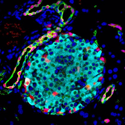 ¿Cómo se destruyen las células Beta en la diabetes mellitus tipo 1