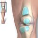 ¿Cuáles son los tipos más frecuentes de Bursitis?