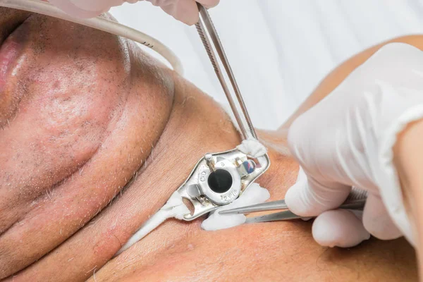 ¿Cuáles son las causas principales de fístula traqueal?