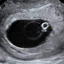 ¿Cómo confirmar un embarazo por laboratorio y ecografía?