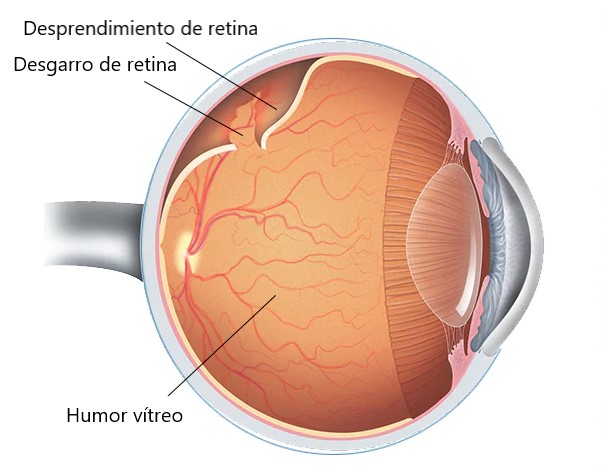 ¿Qué es el desprendimiento de retina regmatógeno?