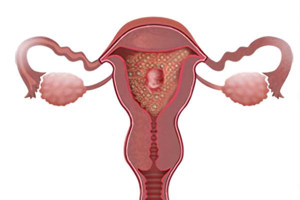¿Cómo se diagnostica la neoplasia trofoblástica maligna?