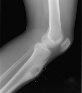 Tumores óseos benignos