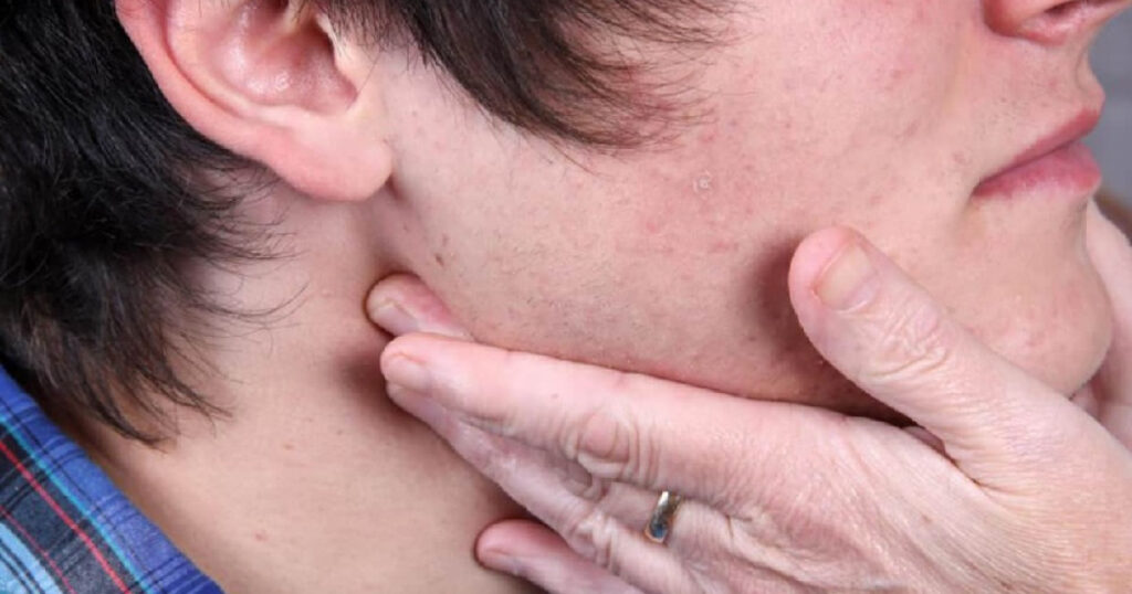 ¿Qué investigar cuando se detecta linfadenopatía?