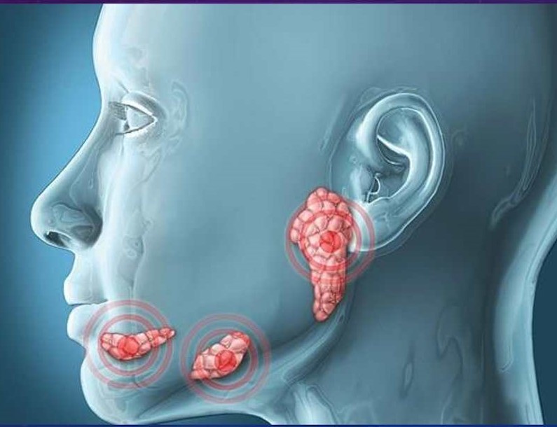 Tumores de las glándulas salivales