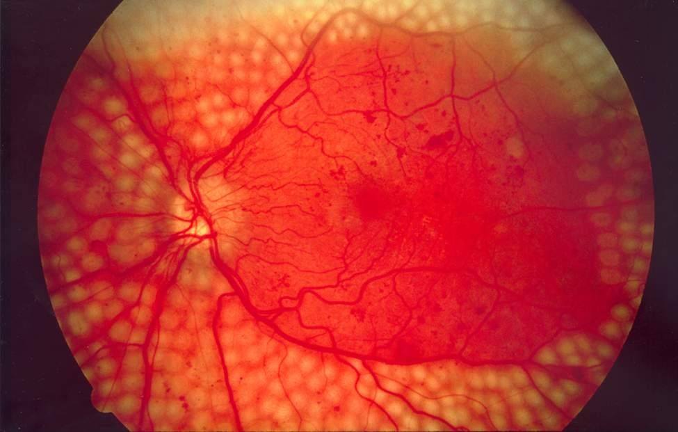 ¿Cuáles son las etapas clínicas de la retinopatía diabética?