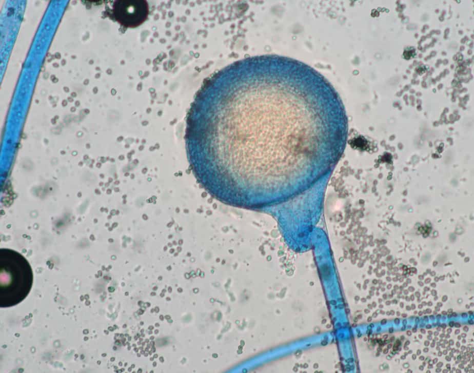 ¿Qué es la mucormicosis?