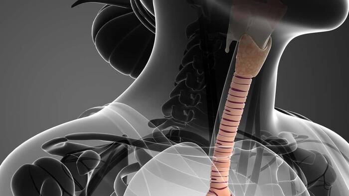 ¿Cuáles son los tipos de neoplasias traqueales?