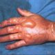¿Cuáles son las causas de la inflamación y edema en pacientes quemados?