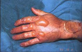 ¿Cuáles son las causas de la inflamación y edema en pacientes quemados?