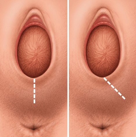 ¿Qué es una episiotomía?