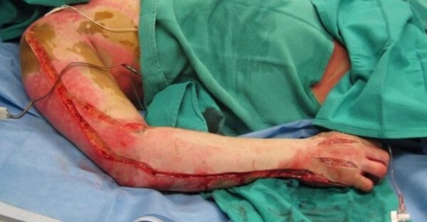 Indicaciones de escarotomía en pacientes quemados