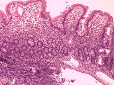 ¿Qué es el linfoma gástrico?