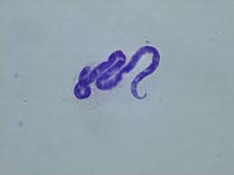 ¿Qué es la oncocercosis?