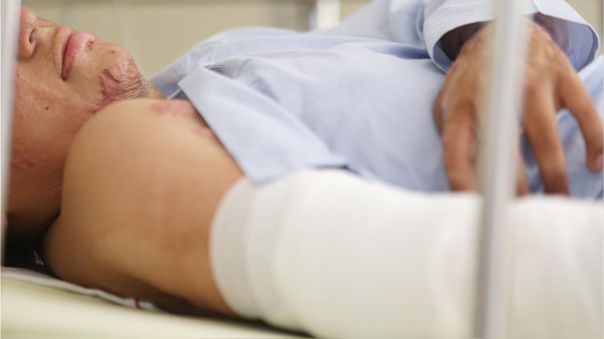 Valoración inicial de pacientes quemados