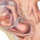 ¿Qué es una presentación fetal pelviana?